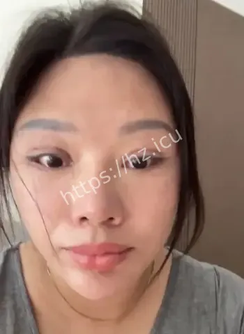 女子割双眼皮无法闭眼